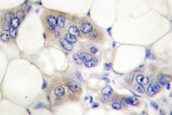 AHR Antibody - IHC of AhR (K32) pAb in paraffin-embedded human breast carcinoma tissue.