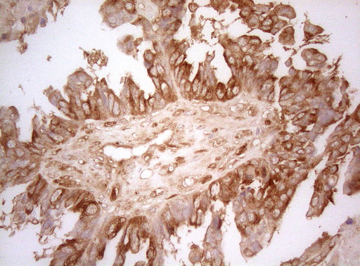 AHSA1 / AHA1 Antibody - Immunohistochemical staining of paraffin-embedded Adenocarcinoma of Human ovary tissue using anti-AHSA1 mouse monoclonal antibody. (Heat-induced epitope retrieval by 1mM EDTA in 10mM Tris buffer. (pH8.5) at 120°C for 3 min. (1:150)