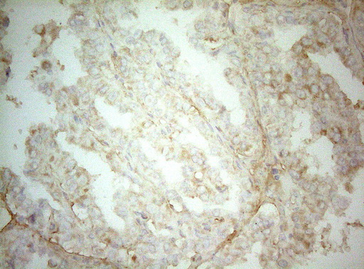 AHSA1 / AHA1 Antibody - Immunohistochemical staining of paraffin-embedded Carcinoma of Human thyroid tissue using anti-AHSA1 mouse monoclonal antibody. (Heat-induced epitope retrieval by 1mM EDTA in 10mM Tris buffer. (pH8.5) at 120°C for 3 min. (1:150)