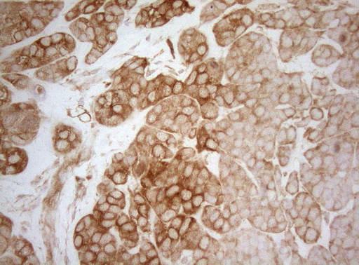 AHSA1 / AHA1 Antibody - Immunohistochemical staining of paraffin-embedded Adenocarcinoma of Human endometrium tissue using anti-AHSA1 mouse monoclonal antibody. (Heat-induced epitope retrieval by 1mM EDTA in 10mM Tris buffer. (pH8.5) at 120°C for 3 min. (1:150)