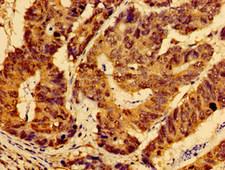 AHSA2 Antibody - Immunohistochemistry of paraffin-embedded human gastric cancer using AHSA2 Antibody at dilution of 1:100