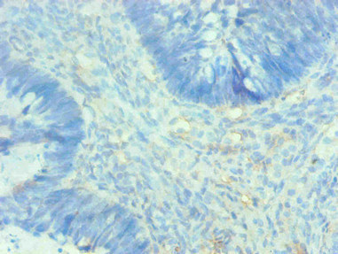 AHSG / Fetuin A Antibody - Immunohistochemical of paraffin-embedded human breast cancer using AHSG Monoclonal Antibody at dilution of 1:200