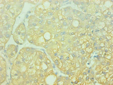 AHSG / Fetuin A Antibody - Immunohistochemical of paraffin-embedded human liver cancer using AHSG Monoclonal Antibody at dilution of 1:200