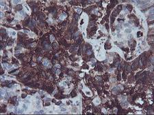 AHSG / Fetuin A Antibody - IHC of paraffin-embedded Adenocarcinoma of Human ovary tissue using anti-AHSG mouse monoclonal antibody.