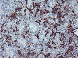 AHSG / Fetuin A Antibody - IHC of paraffin-embedded Carcinoma of Human thyroid tissue using anti-AHSG mouse monoclonal antibody.