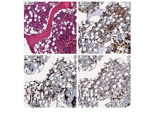 AHSP / EDRF Antibody - Immunohistochemistry of rabbit anti-AHSP antibody. Tissue: A. Normal bone marrow, H&E. B. CD235a stains both nucleated EPs and mature, anucleate RBCs. C. AHSP stains nucleated EPs, but not mature, anucleate RBCs. D. CD71 stains nucleated EPs, but not mature, anucleate RBCs. Fixation: acetic acid-zinc-formalin and formalin fixation, embedded in paraffin Antigen retrieval: TRIS-EDTA pH9.0 Primary antibody: AHSP antibody at 1:8,000 for overnight at 4°C Secondary antibody: anti-rabbit secondary at (1:10,000 for 45 min at RT) Localization: Anti-AHSP is cytoplasmic Staining: AHSP antibody as precipitated brown signal with a purple nuclear counterstain using Bond-max – fully automated for IHC.