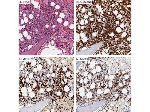 AHSP / EDRF Antibody - Immunohistochemistry of rabbit anti-AHSP antibody. Tissue: A. Acute erythroleukemia, H&E. B. CD235a stains erythroid blasts and mature, anucleate RBCs. C. AHSP stains erythroid blasts. D. CD71 stains erythroid blasts. Fixation: acetic acid-zinc-formalin and formalin fixation, embedded in paraffin Antigen retrieval: TRIS-EDTA pH9.0 Primary antibody: AHSP antibody at 1:8,000 for overnight at 4°C Secondary antibody: anti-rabbit secondary at (1:10,000 for 45 min at RT) Localization: Anti-AHSP is cytoplasmic Staining: AHSP antibody as precipitated brown signal with a purple nuclear counterstain using Bond-max – fully automated for IHC.