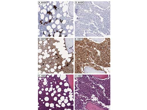 AHSP / EDRF Antibody - Immunohistochemistry of rabbit anti-AHSP antibody. Tissue: AHSP stains residual EPs and not myeloid blasts in acute myeloid leukemia with minimal differentiation (A), whereas CD71 stains both myeloid blasts and EPs (B). AHSP does not stain myeloid blasts in acute myelomonocytic leukemia (D), whereas CD71 does (E). C and F are corresponding H&Es, respectively. Fixation: acetic acid-zinc-formalin and formalin fixation, embedded in paraffin Antigen retrieval: TRIS-EDTA pH9.0 Primary antibody: AHSP antibody at 1:8,000 for overnight at 4°C Secondary antibody: anti-rabbit secondary at (1:10,000 for 45 min at RT) Localization: Anti-AHSP is cytoplasmic Staining: AHSP antibody as precipitated brown signal with a purple nuclear counterstain using Bond-max – fully automated for IHC.