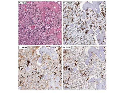 AHSP / EDRF Antibody - Immunohistochemistry of rabbit anti-AHSP antibody. Tissue: A. Primary myelofibrosis, H&E. B. CD235a stains both nucleated EPs and mature, anucleate RBCs. AHSP C. and CD71 D. variably stain megakaryocytes and also stain nucleated EPs. Fixation: acetic acid-zinc-formalin and formalin fixation, embedded in paraffin Antigen retrieval: TRIS-EDTA pH9.0 Primary antibody: AHSP antibody at 1:8,000 for overnight at 4°C Secondary antibody: anti-rabbit secondary at (1:10,000 for 45 min at RT) Localization: Anti-AHSP is cytoplasmic Staining: AHSP antibody as precipitated brown signal with a purple nuclear counterstain using Bond-max – fully automated for IHC.