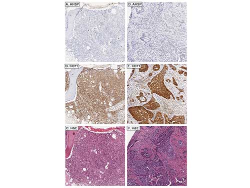 AHSP / EDRF Antibody - Immunohistochemistry of rabbit anti-AHSP antibody. Tissue: AHSP A. stains residual EPs and not lymphoma cells in DLBCL, whereas CD71 B. stains both lymphomacells and EPs. C. Corresponding H&E. AHSP D. does not metastatic carcinoma, whereas CD71 E. does. F. Corresponding H&E. Fixation: acetic acid-zinc-formalin and formalin fixation, embedded in paraffin Antigen retrieval: TRIS-EDTA pH9.0 Primary antibody: AHSP antibody at 1:8,000 for overnight at 4°C Secondary antibody: anti-rabbit secondary at (1:10,000 for 45 min at RT) Localization: Anti-AHSP is cytoplasmic Staining: AHSP antibody as precipitated brown signal with a purple nuclear counterstain using Bond-max – fully automated for IHC.