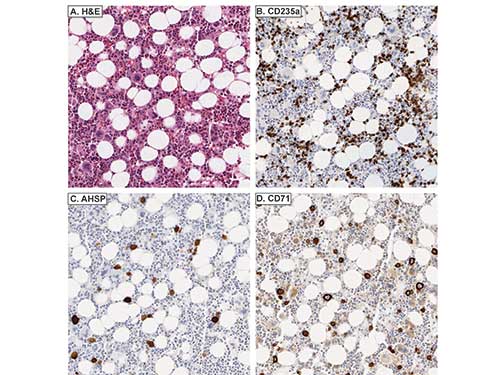AHSP / EDRF Antibody - Immunohistochemistry of rabbit anti-AHSP antibody. Tissue: Giant pronormoblasts are evident in parvoviral infection (H&E, A). B. CD235a does not stain giant pronormoblasts. AHSP C. and CD71 D. stain giant pronormoblasts. Fixation: acetic acid-zinc-formalin and formalin fixation, embedded in paraffin Antigen retrieval: TRIS-EDTA pH9.0 Primary antibody: AHSP antibody at 1:8,000 for overnight at 4°C Secondary antibody: anti-rabbit secondary at (1:10,000 for 45 min at RT) Localization: Anti-AHSP is cytoplasmic Staining: AHSP antibody as precipitated brown signal with a purple nuclear counterstain using Bond-max – fully automated for IHC.