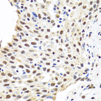 AHSP / EDRF Antibody - Immunohistochemistry of paraffin-embedded human lung cancer tissue.