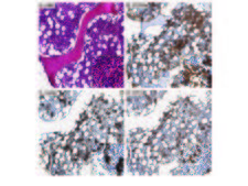 AHSP / EDRF Antibody - Immunohistochemistry of Rabbit anti-AHSP antibody. Tissue: A. Normal bone marrow, H&E. B. CD235a stains both nucleated EPs and mature, anucleate RBCs. C. AHSP stains nucleated EPs, but not mature, anucleate RBCs. D. CD71 stains nucleated EPs, but not mature, anucleate RBCs. Fixation: acetic acid-zinc-formalin and formalin fixation, embedded in paraffin Antigen retrieval: TRIS-EDTA pH9.0 Primary antibody: AHSP antibody at 1:8000 for overnight at 4°C Secondary antibody: anti-rabbit secondary at (1:10000 for 45 min at RT) Localization: Anti-AHSP is cytoplasmic Staining: AHSP antibody as precipitated brown signal with a purple nuclear counterstain using Bond-max fully automated for IHC.
