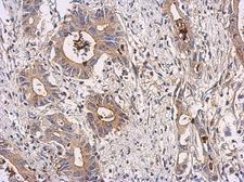 AICAR / ATIC Antibody - IHC of paraffin-embedded Colon ca using ATIC antibody at 1:100 dilution.