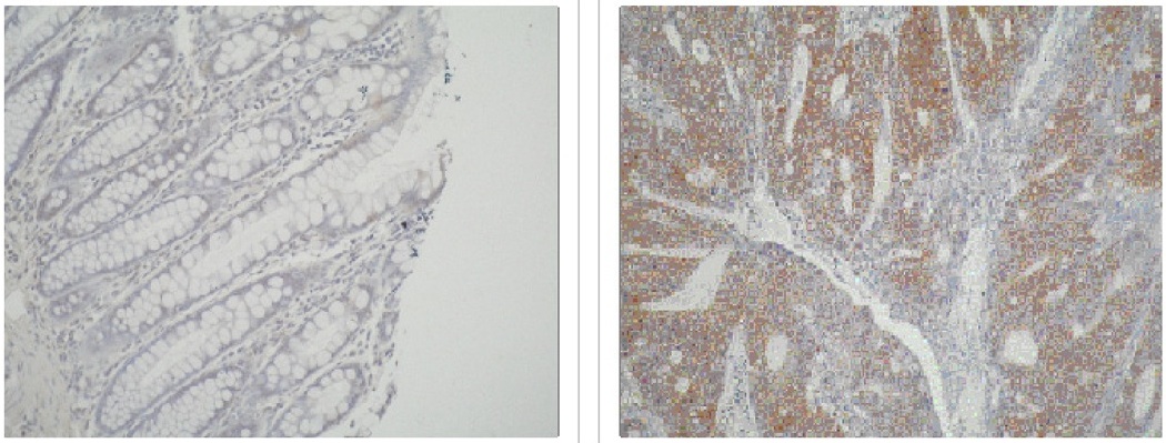 AICAR / ATIC Antibody - Left and Center: IHC of normal colon tissue and colon carcinoma tissue using ATIC antibody (ATIC). Right: Western blot of ATIC antibody on HT29 cell lysate.