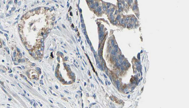 AICAR / ATIC Antibody - 1:100 staining human prostate tissue by IHC-P. The sample was formaldehyde fixed and a heat mediated antigen retrieval step in citrate buffer was performed. The sample was then blocked and incubated with the antibody for 1.5 hours at 22°C. An HRP conjugated goat anti-rabbit antibody was used as the secondary.