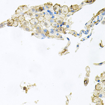 AIF1 / IBA1 Antibody - Immunohistochemistry of paraffin-embedded human lung injury using AIF1 antibodyat dilution of 1:100 (40x lens).