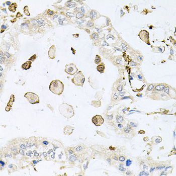 AIF1 / IBA1 Antibody - Immunohistochemistry of paraffin-embedded human gastric cancer using AIF1 antibodyat dilution of 1:100 (40x lens).