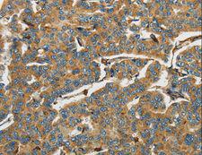AIF1 / IBA1 Antibody - Immunohistochemistry of paraffin-embedded Human breast cancer using AIF1 Polyclonal Antibody at dilution of 1:40.