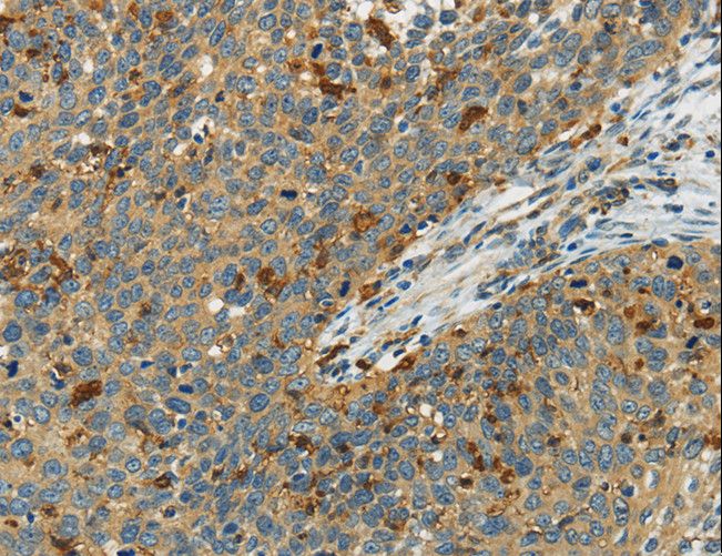 AIF1 / IBA1 Antibody - Immunohistochemistry of paraffin-embedded Human cervical cancer using AIF1 Polyclonal Antibody at dilution of 1:40.