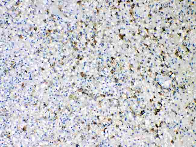 AIF1 / IBA1 Antibody - Iba1 was detected in paraffin-embedded sections of human Appendicitis tissues using rabbit anti- Iba1 Antigen Affinity purified polyclonal antibody
