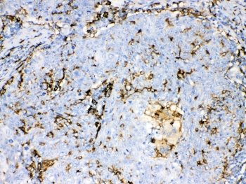 AIF1 / IBA1 Antibody - IHC testing of FFPE human lung cancer tissue with IBA1 antibody at 1ug/ml. Required HIER: steam section in pH6 citrate buffer for 20 min and allow to cool prior to testing.