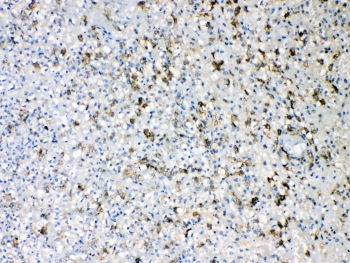 AIF1 / IBA1 Antibody - IHC testing of FFPE human appendicitis tissue with IBA1 antibody at 1ug/ml. Required HIER: steam section in pH6 citrate buffer for 20 min and allow to cool prior to testing.