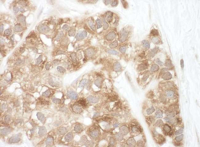 AIFM1 / AIF / PDCD8 Antibody - Detection of Human AIF by Immunohistochemistry. Sample: FFPE section of human breast carcinoma. Antibody: Affinity purified rabbit anti-AIF used at a dilution of 1:200 (1 ug/ml).