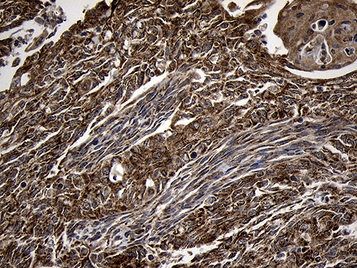 AIFM1 / AIF / PDCD8 Antibody - Immunohistochemical staining of paraffin-embedded Adenocarcinoma of Human endometrium tissue using anti-AIFM1 mouse monoclonal antibody. (Heat-induced epitope retrieval by 1mM EDTA in 10mM Tris buffer. (pH8.5) at 120°C for 3 min. (1:500)