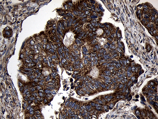 AIFM1 / AIF / PDCD8 Antibody - Immunohistochemical staining of paraffin-embedded Adenocarcinoma of Human colon tissue using anti-AIFM1 mouse monoclonal antibody. (Heat-induced epitope retrieval by 1mM EDTA in 10mM Tris buffer. (pH8.5) at 120°C for 3 min. (1:500)