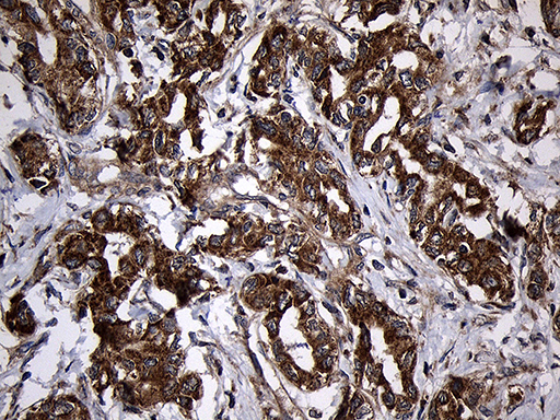 AIFM1 / AIF / PDCD8 Antibody - Immunohistochemical staining of paraffin-embedded Carcinoma of Human liver tissue using anti-AIFM1 mouse monoclonal antibody. (Heat-induced epitope retrieval by 1mM EDTA in 10mM Tris buffer. (pH8.5) at 120°C for 3 min. (1:500)