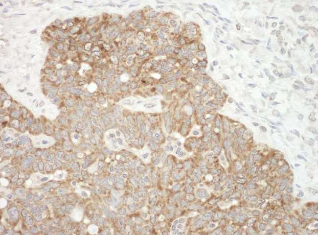 AIFM1 / AIF / PDCD8 Antibody - Detection of Human AIF by Immunohistochemistry. Sample: FFPE section of human ovarian carcinoma. Antibody: Affinity purified rabbit anti-AIF used at a dilution of 1:1000 (1 ug/mg).