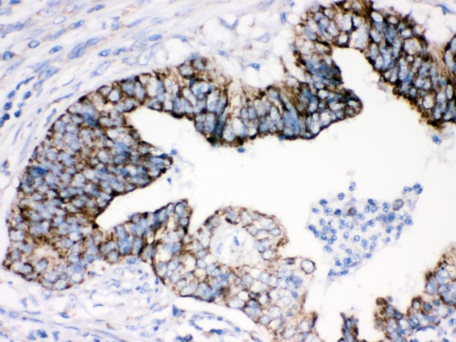 AIFM1 / AIF / PDCD8 Antibody - AIF antibody IHC-paraffin: Human Intestinal Cancer Tissue.