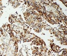 AIFM1 / AIF / PDCD8 Antibody - AIFM1 / AIF antibody. IHC(P): Human Lung Cancer Tissue.