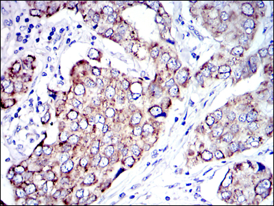 AIFM1 / AIF / PDCD8 Antibody - IHC of paraffin-embedded human breast cancer tissues using AIF mouse monoclonal antibody with DAB staining.