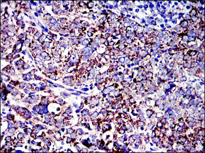 AIFM1 / AIF / PDCD8 Antibody - IHC of paraffin-embedded human cervical cancer tissues using AIF mouse monoclonal antibody with DAB staining.