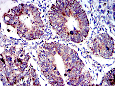 AIFM1 / AIF / PDCD8 Antibody - IHC of paraffin-embedded human rectum cancer tissues using AIF mouse monoclonal antibody with DAB staining.