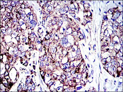 AIFM1 / AIF / PDCD8 Antibody - IHC of paraffin-embedded human lung cancer tissues using AIF mouse monoclonal antibody with DAB staining.