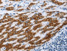 AIFM1 / AIF / PDCD8 Antibody - Immunohistochemistry of paraffin-embedded Human liver cancer using AIFM1 Polyclonal Antibody at dilution of 1:30.