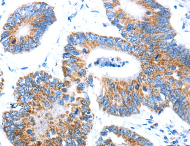 AIFM1 / AIF / PDCD8 Antibody - Immunohistochemistry of paraffin-embedded Human colon cancer using AIFM1 Polyclonal Antibody at dilution of 1:30.