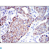 AIFM1 / AIF / PDCD8 Antibody - Immunohistochemistry (IHC) analysis of paraffin-embedded Human Breast cancer tissues with DAB staining using AIF-M1 Monoclonal Antibody.