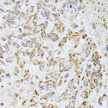 AIFM3 Antibody - Immunohistochemistry of paraffin-embedded human lung cancer tissue.