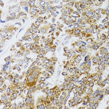 AIFM3 Antibody - Immunohistochemistry of paraffin-embedded human liver cancer tissue.