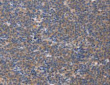 AIM / CD5L Antibody - Immunohistochemistry of paraffin-embedded Human liver cancer using CD5L Polyclonal Antibody at dilution of 1:40.