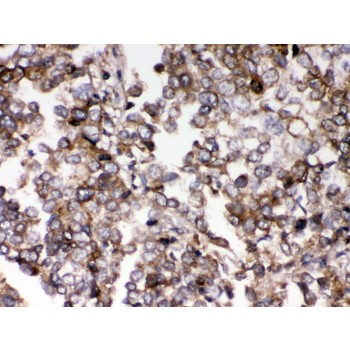 AIM2 Antibody - AIM2 antibody IHC-paraffin. IHC(P): Human Lung Cancer Tissue.