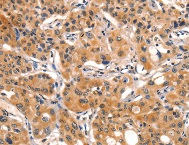 AIM2 Antibody - Immunohistochemistry of paraffin-embedded Human lung cancer using AIM2 Polyclonal Antibody at dilution of 1:60.