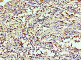 AIMP1 / EMAP II Antibody - Immunohistochemistry of paraffin-embedded human cervical cancer using antibody at 1:100 dilution.