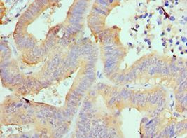 AIMP1 / EMAP II Antibody - Immunohistochemistry of paraffin-embedded human colon cancer using antibody at 1:100 dilution.
