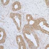 AIMP1 / EMAP II Antibody - Detection of human AIMP1/EMAPII by immunohistochemistry. Sample: FFPE section of human prostate carcinoma. Antibody: Affinity purified rabbit anti- AIMP1/EMAPII used at a dilution of 1:1,000 (1µg/ml). Detection: DAB