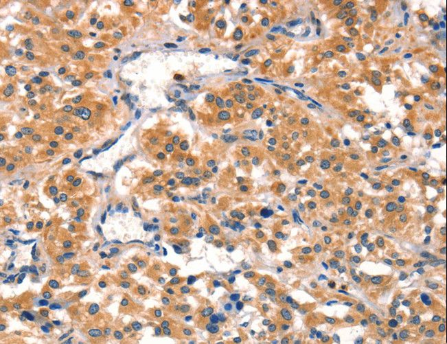 AIMP1 / EMAP II Antibody - Immunohistochemistry of paraffin-embedded Human thyroid cancer using AIMP1 Polyclonal Antibody at dilution of 1:40.